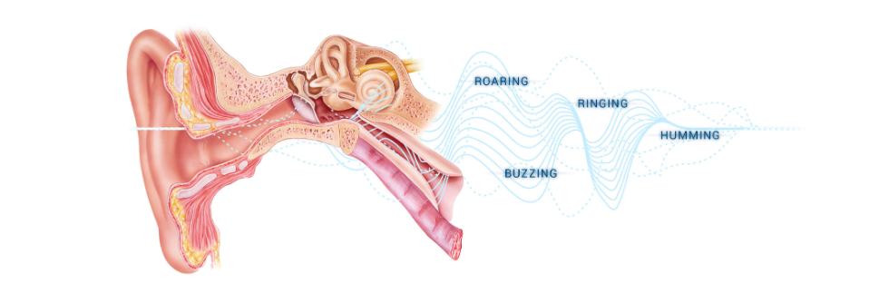 phantom perception of tinnitus